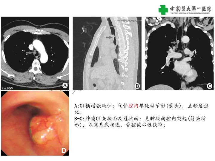 影像PPT - 【病例】气管腺样囊性癌1例CT影像-14