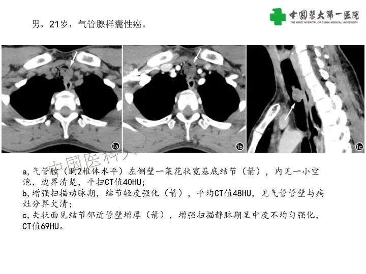 影像PPT - 【病例】气管腺样囊性癌1例CT影像-15