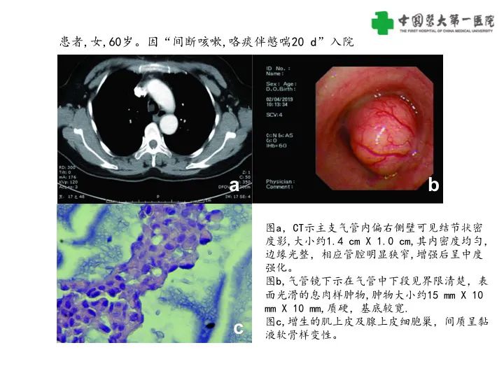 影像PPT - 【病例】气管腺样囊性癌1例CT影像-19