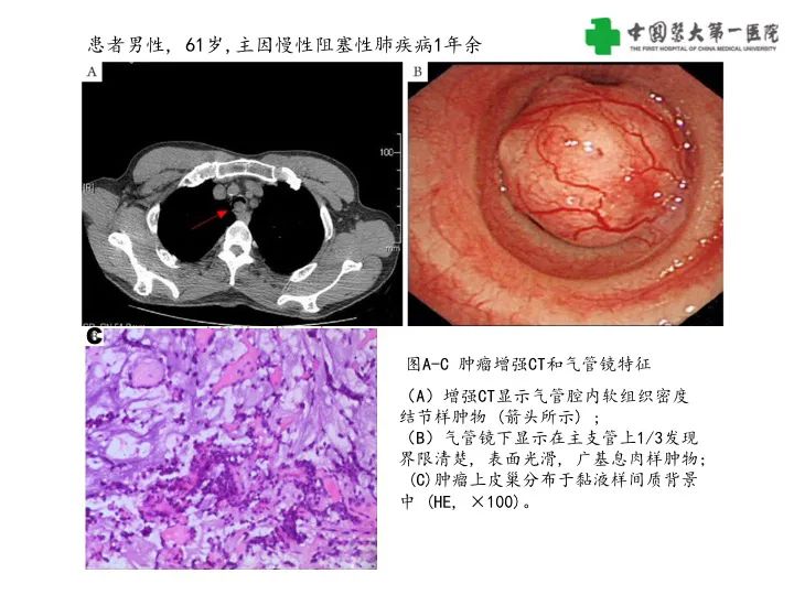 影像PPT - 【病例】气管腺样囊性癌1例CT影像-20