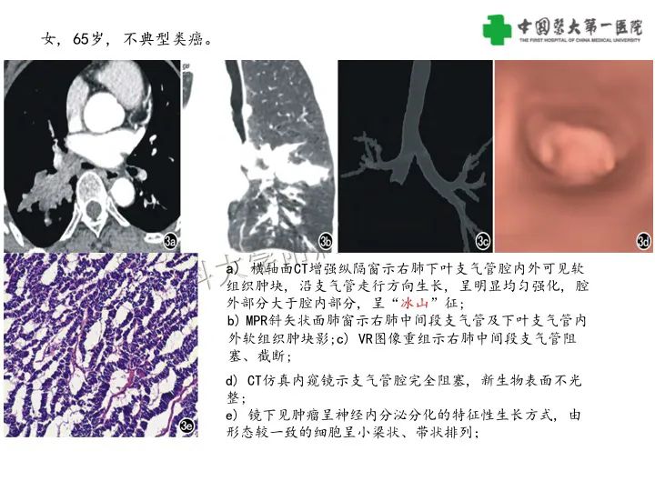 影像PPT - 【病例】气管腺样囊性癌1例CT影像-22