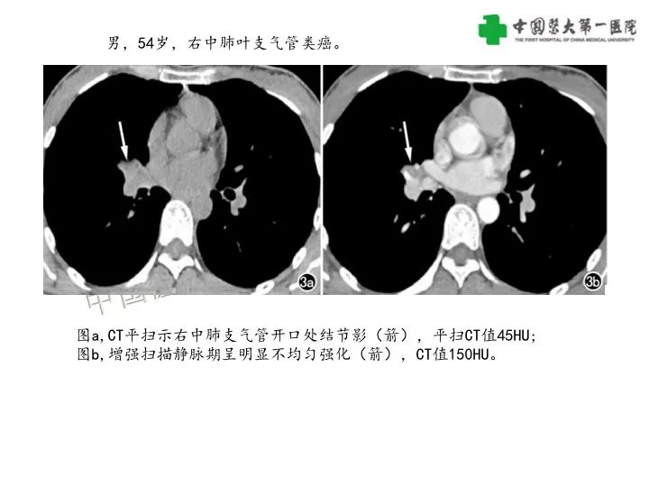 影像PPT - 【病例】气管腺样囊性癌1例CT影像-23