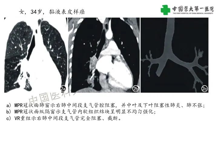 影像PPT - 【病例】气管腺样囊性癌1例CT影像-26