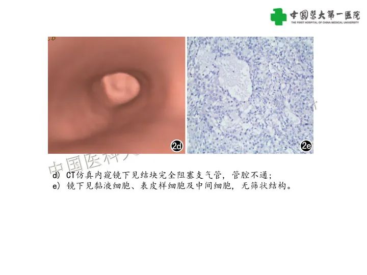 影像PPT - 【病例】气管腺样囊性癌1例CT影像-27