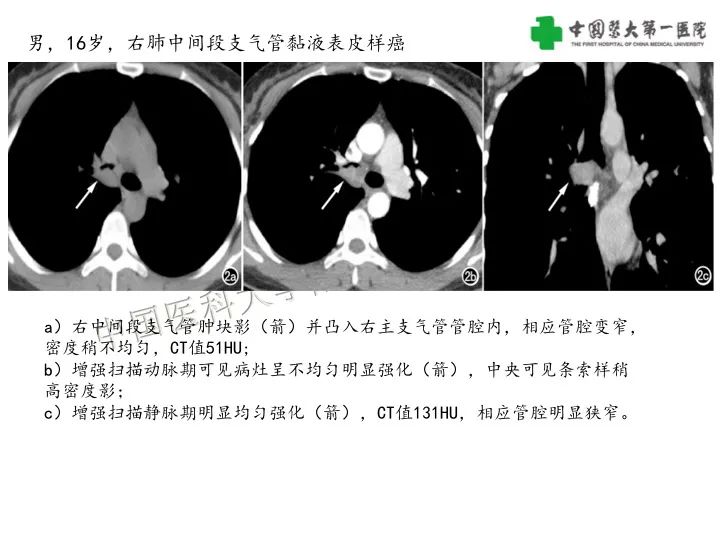 影像PPT - 【病例】气管腺样囊性癌1例CT影像-28