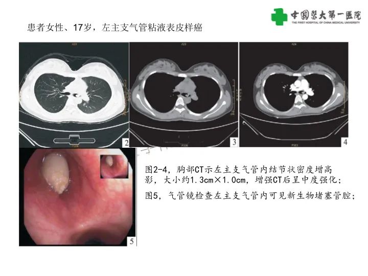 影像PPT - 【病例】气管腺样囊性癌1例CT影像-29