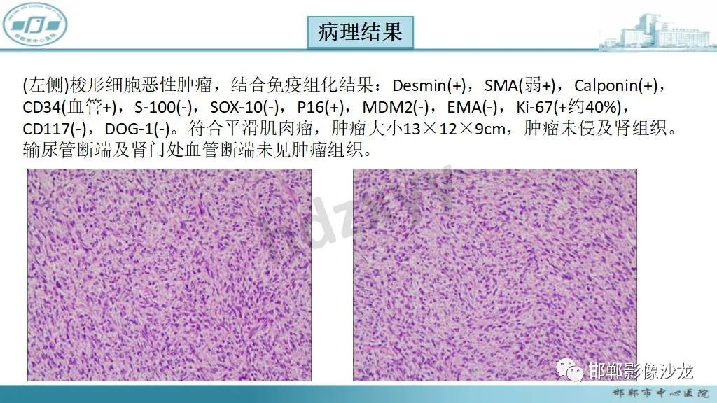 影像PPT - 【病例】肾上腺平滑肌肉瘤1例MR影像-19 影像PPT - 【病例】肾上腺平滑肌肉瘤1例MR影像-19
