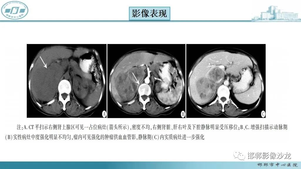 影像PPT - 【病例】肾上腺平滑肌肉瘤1例MR影像-24 影像PPT - 【病例】肾上腺平滑肌肉瘤1例MR影像-24