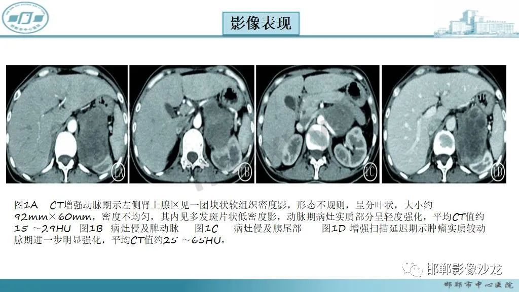 影像PPT - 【病例】肾上腺平滑肌肉瘤1例MR影像-25 影像PPT - 【病例】肾上腺平滑肌肉瘤1例MR影像-25