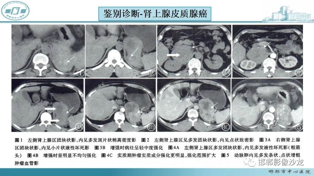 影像PPT - 【病例】肾上腺平滑肌肉瘤1例MR影像-32 影像PPT - 【病例】肾上腺平滑肌肉瘤1例MR影像-32