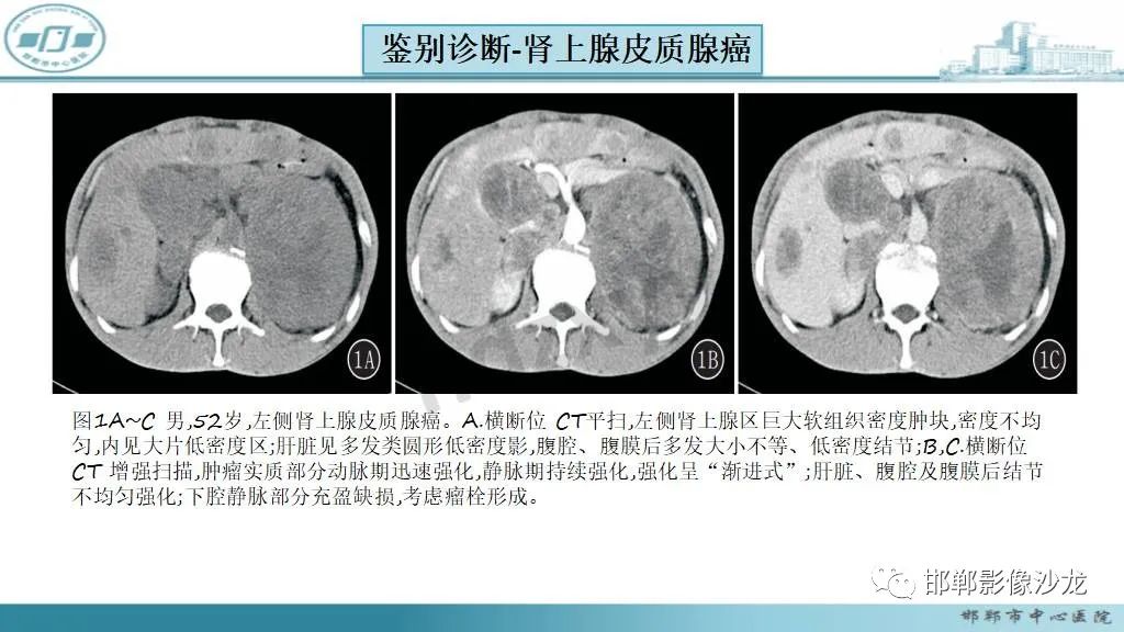 影像PPT - 【病例】肾上腺平滑肌肉瘤1例MR影像-33 影像PPT - 【病例】肾上腺平滑肌肉瘤1例MR影像-33
