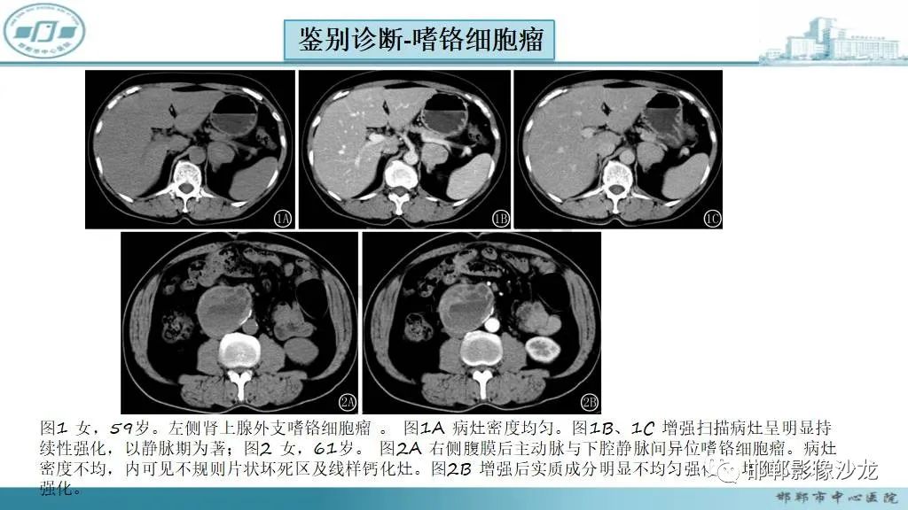 影像PPT - 【病例】肾上腺平滑肌肉瘤1例MR影像-36 影像PPT - 【病例】肾上腺平滑肌肉瘤1例MR影像-36