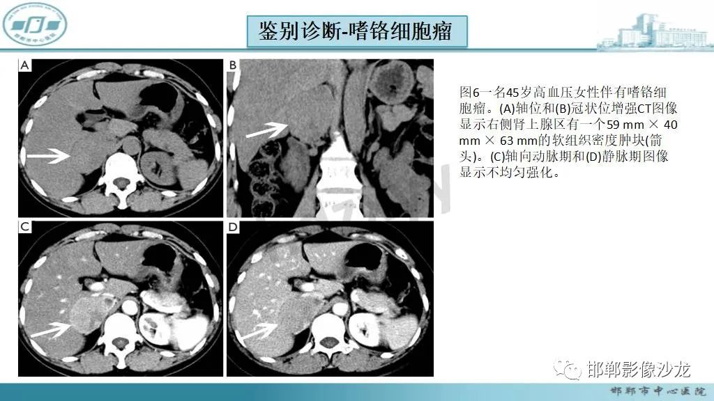 影像PPT - 【病例】肾上腺平滑肌肉瘤1例MR影像-37 影像PPT - 【病例】肾上腺平滑肌肉瘤1例MR影像-37