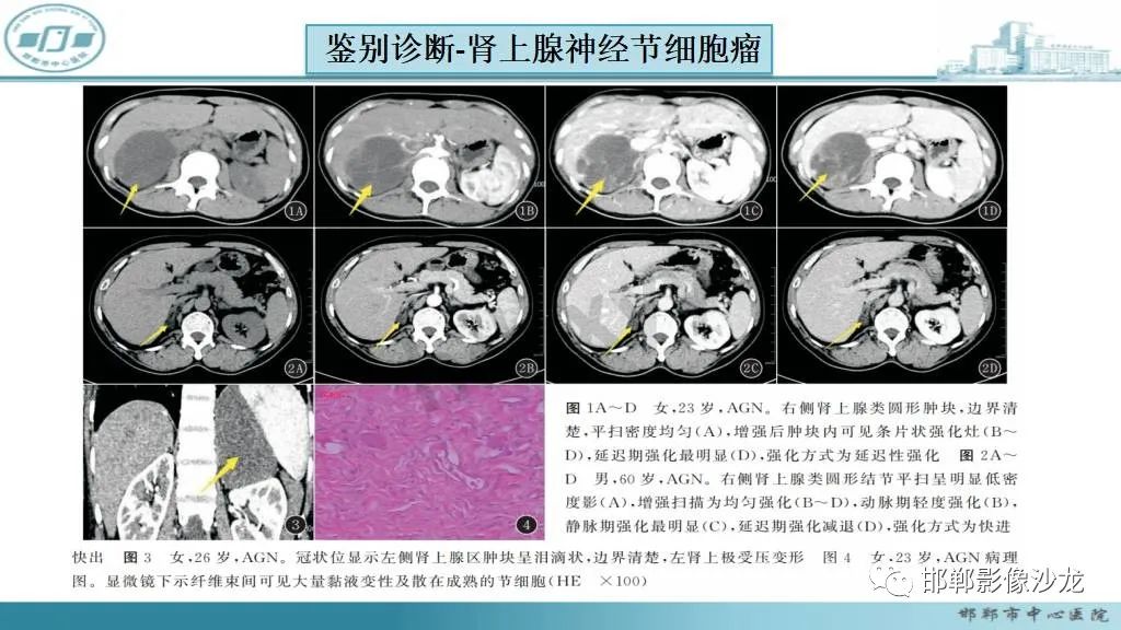 影像PPT - 【病例】肾上腺平滑肌肉瘤1例MR影像-40 影像PPT - 【病例】肾上腺平滑肌肉瘤1例MR影像-40