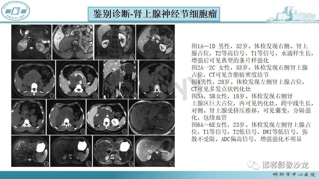 影像PPT - 【病例】肾上腺平滑肌肉瘤1例MR影像-41 影像PPT - 【病例】肾上腺平滑肌肉瘤1例MR影像-41
