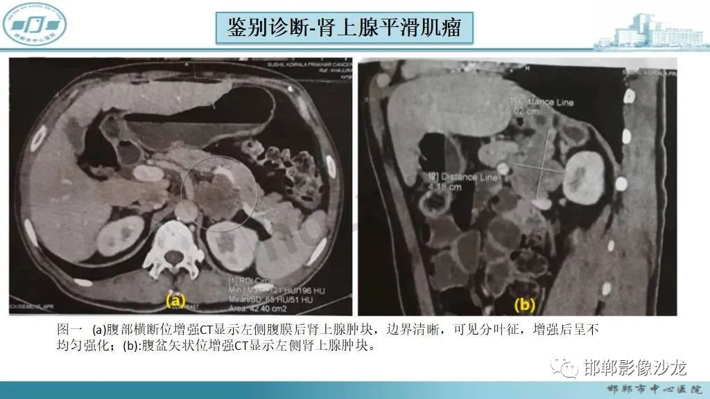 影像PPT - 【病例】肾上腺平滑肌肉瘤1例MR影像-43 影像PPT - 【病例】肾上腺平滑肌肉瘤1例MR影像-43