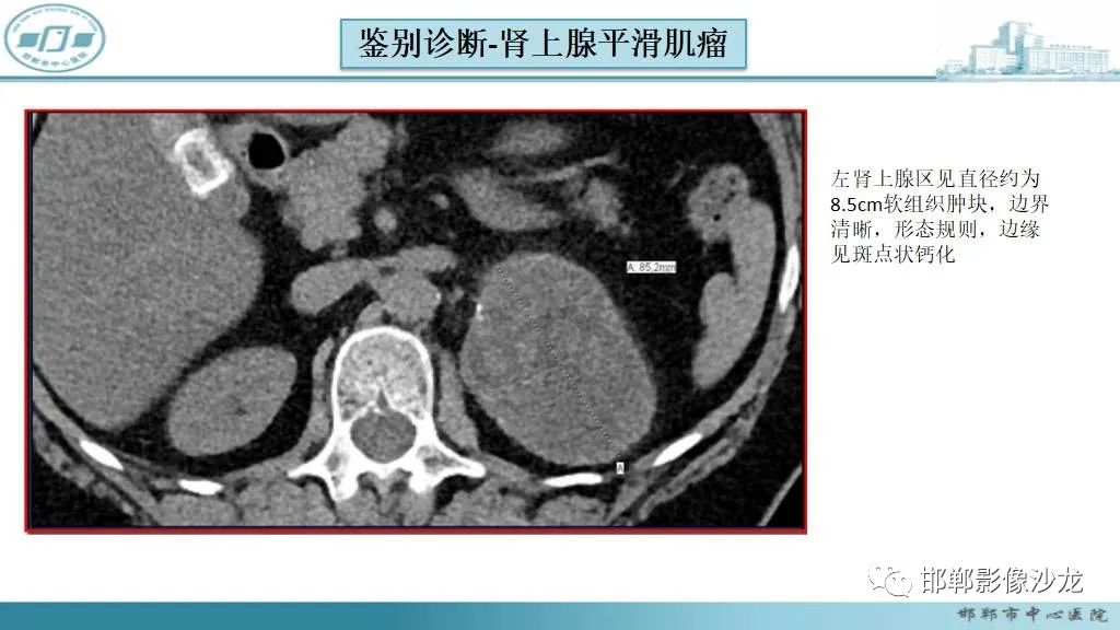 影像PPT - 【病例】肾上腺平滑肌肉瘤1例MR影像-44 影像PPT - 【病例】肾上腺平滑肌肉瘤1例MR影像-44