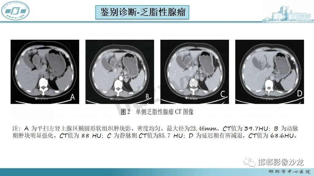 影像PPT - 【病例】肾上腺平滑肌肉瘤1例MR影像-47 影像PPT - 【病例】肾上腺平滑肌肉瘤1例MR影像-47