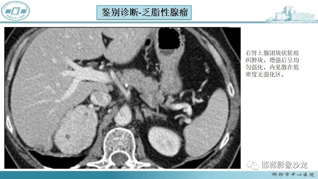 影像PPT - 【病例】肾上腺平滑肌肉瘤1例MR影像-46 影像PPT - 【病例】肾上腺平滑肌肉瘤1例MR影像-46