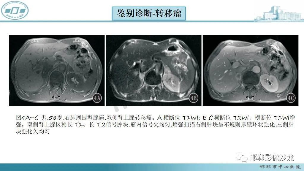 影像PPT - 【病例】肾上腺平滑肌肉瘤1例MR影像-49 影像PPT - 【病例】肾上腺平滑肌肉瘤1例MR影像-49