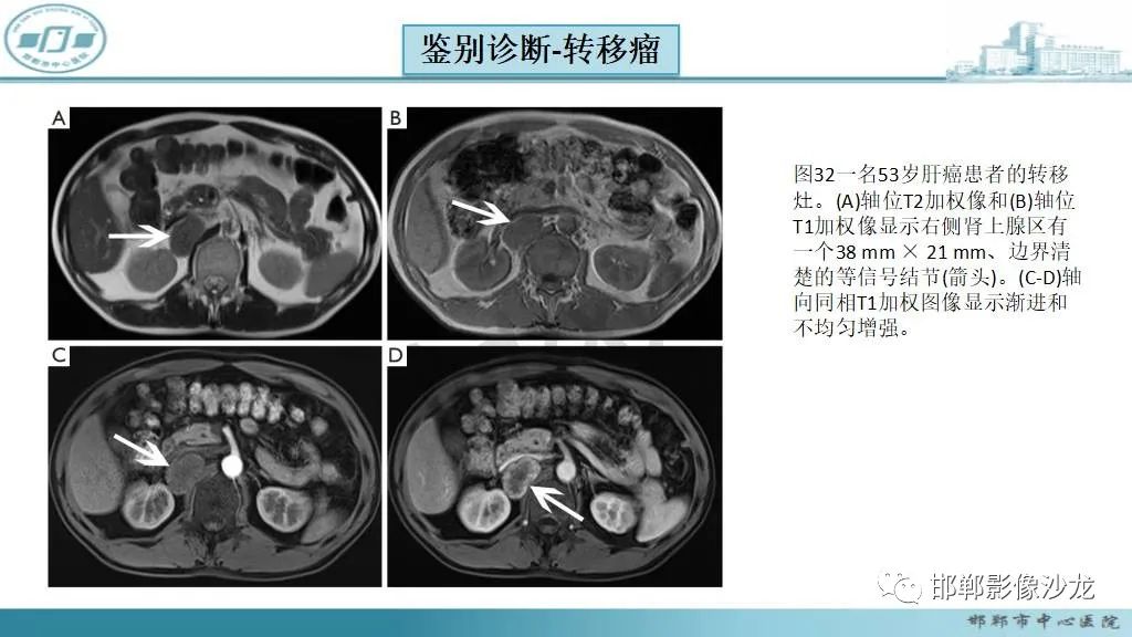 影像PPT - 【病例】肾上腺平滑肌肉瘤1例MR影像-50 影像PPT - 【病例】肾上腺平滑肌肉瘤1例MR影像-50