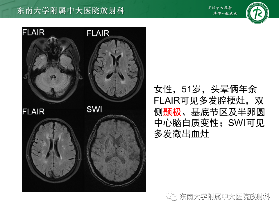 影像PPT - 【PPT】伴有皮质下梗死和白质脑病的常染色体显性遗传性脑动脉病(CADASIL)-2