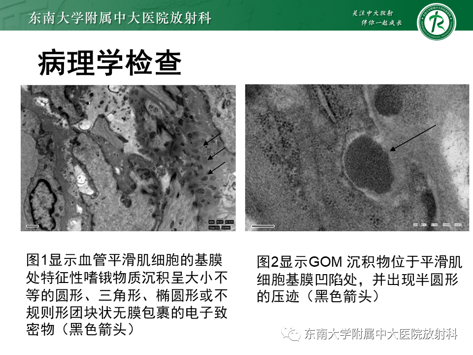影像PPT - 【PPT】伴有皮质下梗死和白质脑病的常染色体显性遗传性脑动脉病(CADASIL)-8