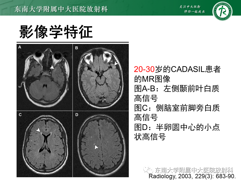 影像PPT - 【PPT】伴有皮质下梗死和白质脑病的常染色体显性遗传性脑动脉病(CADASIL)-14