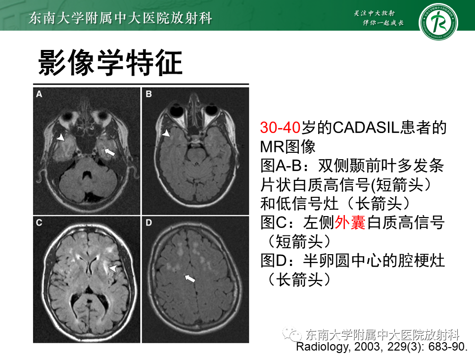影像PPT - 【PPT】伴有皮质下梗死和白质脑病的常染色体显性遗传性脑动脉病(CADASIL)-15