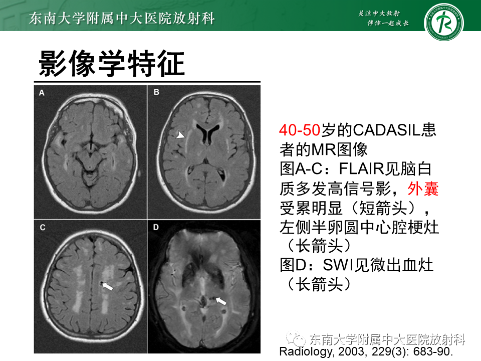 影像PPT - 【PPT】伴有皮质下梗死和白质脑病的常染色体显性遗传性脑动脉病(CADASIL)-16