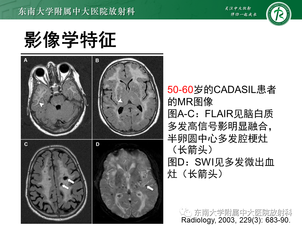 影像PPT - 【PPT】伴有皮质下梗死和白质脑病的常染色体显性遗传性脑动脉病(CADASIL)-17