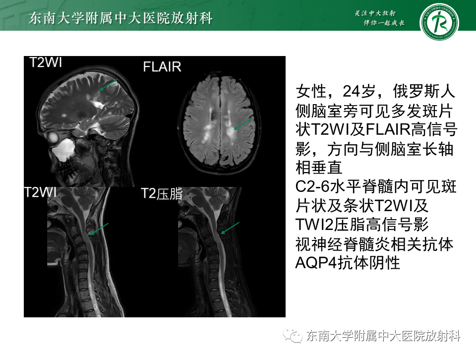 影像PPT - 【PPT】伴有皮质下梗死和白质脑病的常染色体显性遗传性脑动脉病(CADASIL)-24