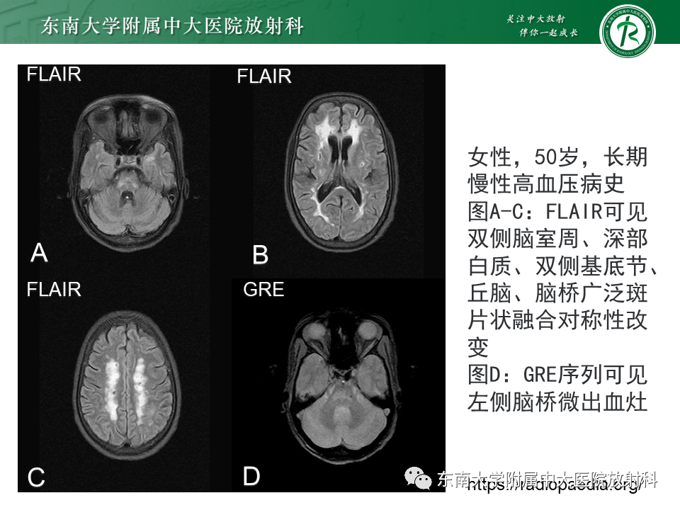 影像PPT - 【PPT】伴有皮质下梗死和白质脑病的常染色体显性遗传性脑动脉病(CADASIL)-26