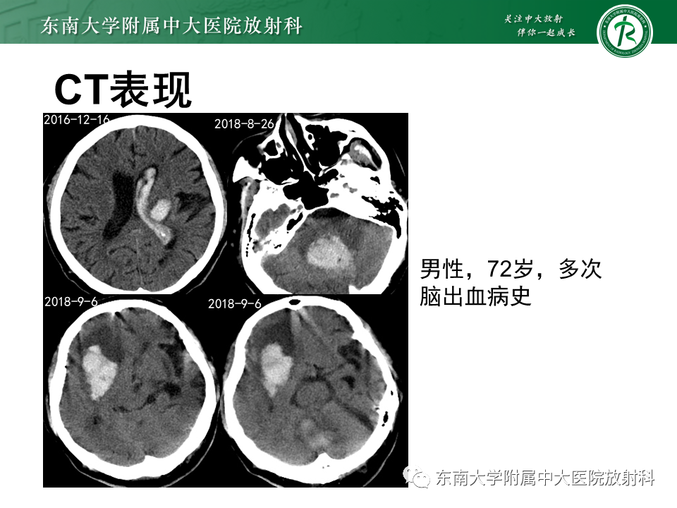 影像PPT - 【PPT】伴有皮质下梗死和白质脑病的常染色体显性遗传性脑动脉病(CADASIL)-29