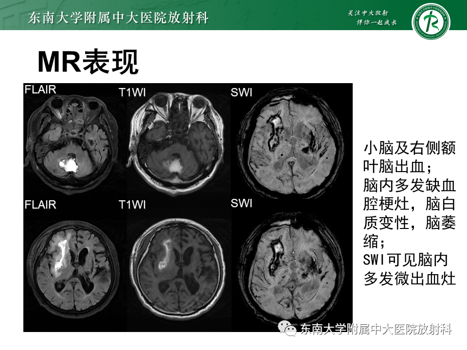 影像PPT - 【PPT】伴有皮质下梗死和白质脑病的常染色体显性遗传性脑动脉病(CADASIL)-30