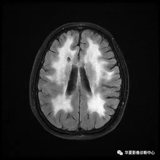 影像PPT - “雪山征”—CADASIL-5 影像PPT - “雪山征”—CADASIL-5