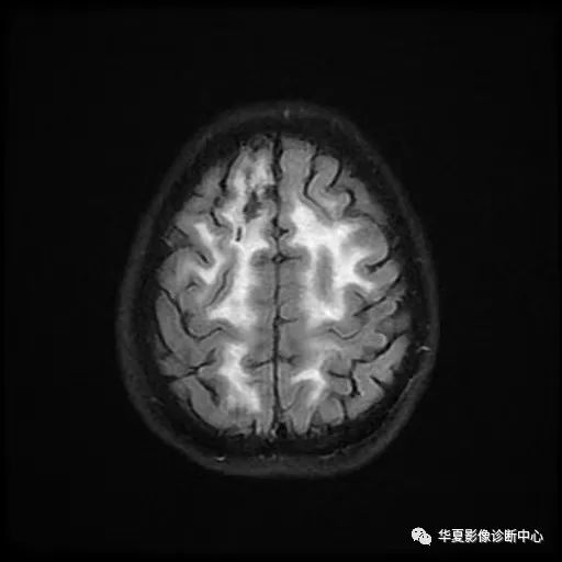 影像PPT - “雪山征”—CADASIL-7 影像PPT - “雪山征”—CADASIL-7
