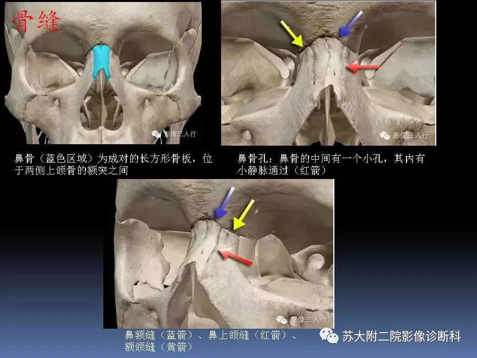 影像PPT - 【PPT】鼻骨骨折影像诊断误区-5