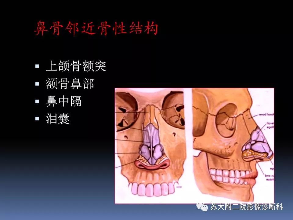 影像PPT - 【PPT】鼻骨骨折影像诊断误区-4