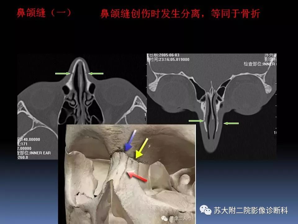 影像PPT - 【PPT】鼻骨骨折影像诊断误区-6