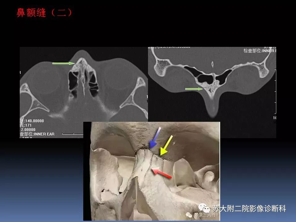 影像PPT - 【PPT】鼻骨骨折影像诊断误区-7