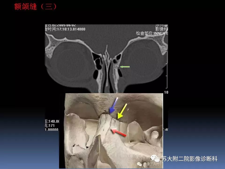 影像PPT - 【PPT】鼻骨骨折影像诊断误区-8