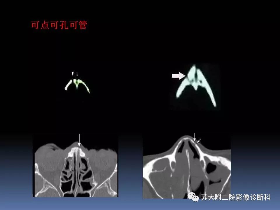 影像PPT - 【PPT】鼻骨骨折影像诊断误区-11