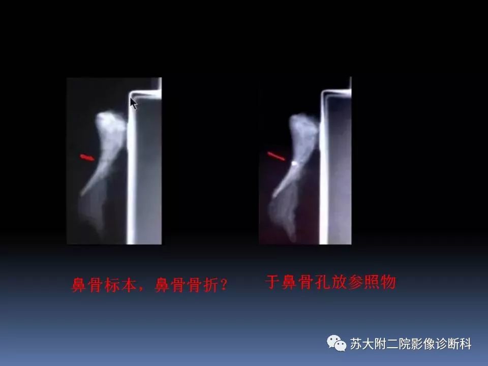 影像PPT - 【PPT】鼻骨骨折影像诊断误区-12