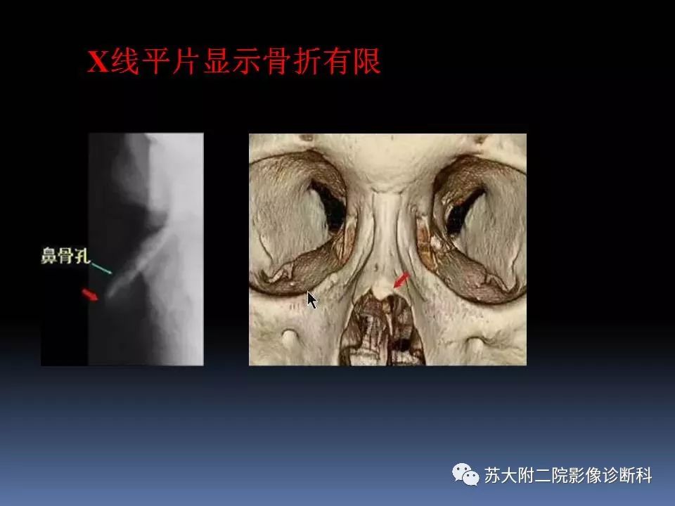 影像PPT - 【PPT】鼻骨骨折影像诊断误区-17
