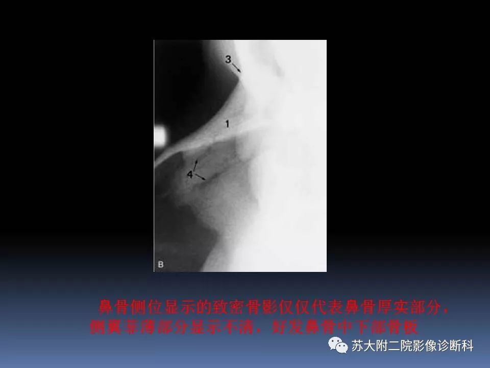 影像PPT - 【PPT】鼻骨骨折影像诊断误区-18