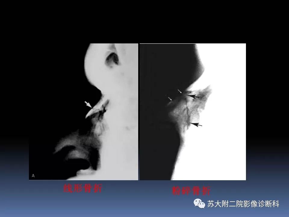 影像PPT - 【PPT】鼻骨骨折影像诊断误区-19