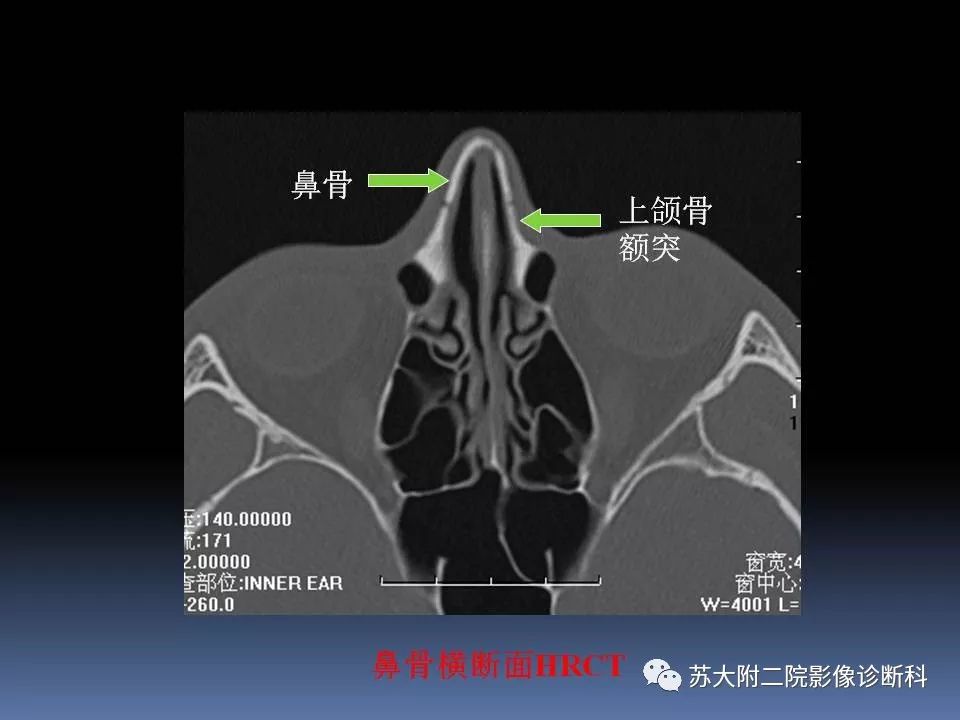 影像PPT - 【PPT】鼻骨骨折影像诊断误区-20