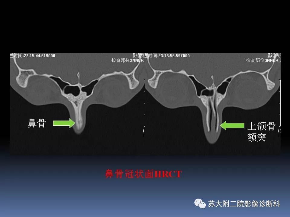 影像PPT - 【PPT】鼻骨骨折影像诊断误区-21