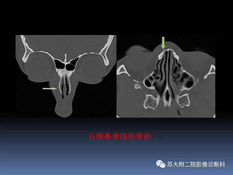 影像PPT - 【PPT】鼻骨骨折影像诊断误区-23